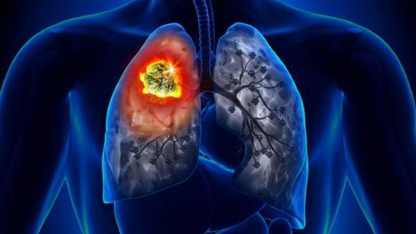 مهمترین نشانه های سرطان ریه