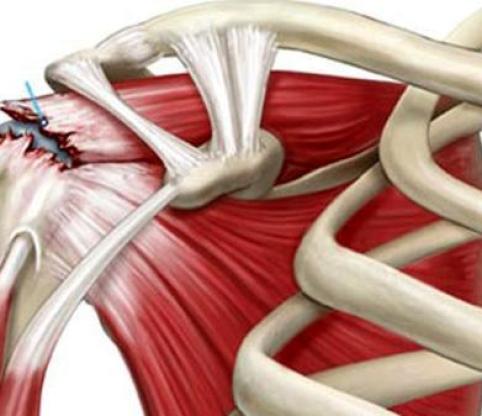 همه چیز درباره پارگی تاندون ها