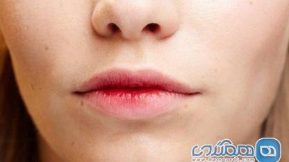 تغییر رنگ لب ها نشانه کدام بیماری است؟